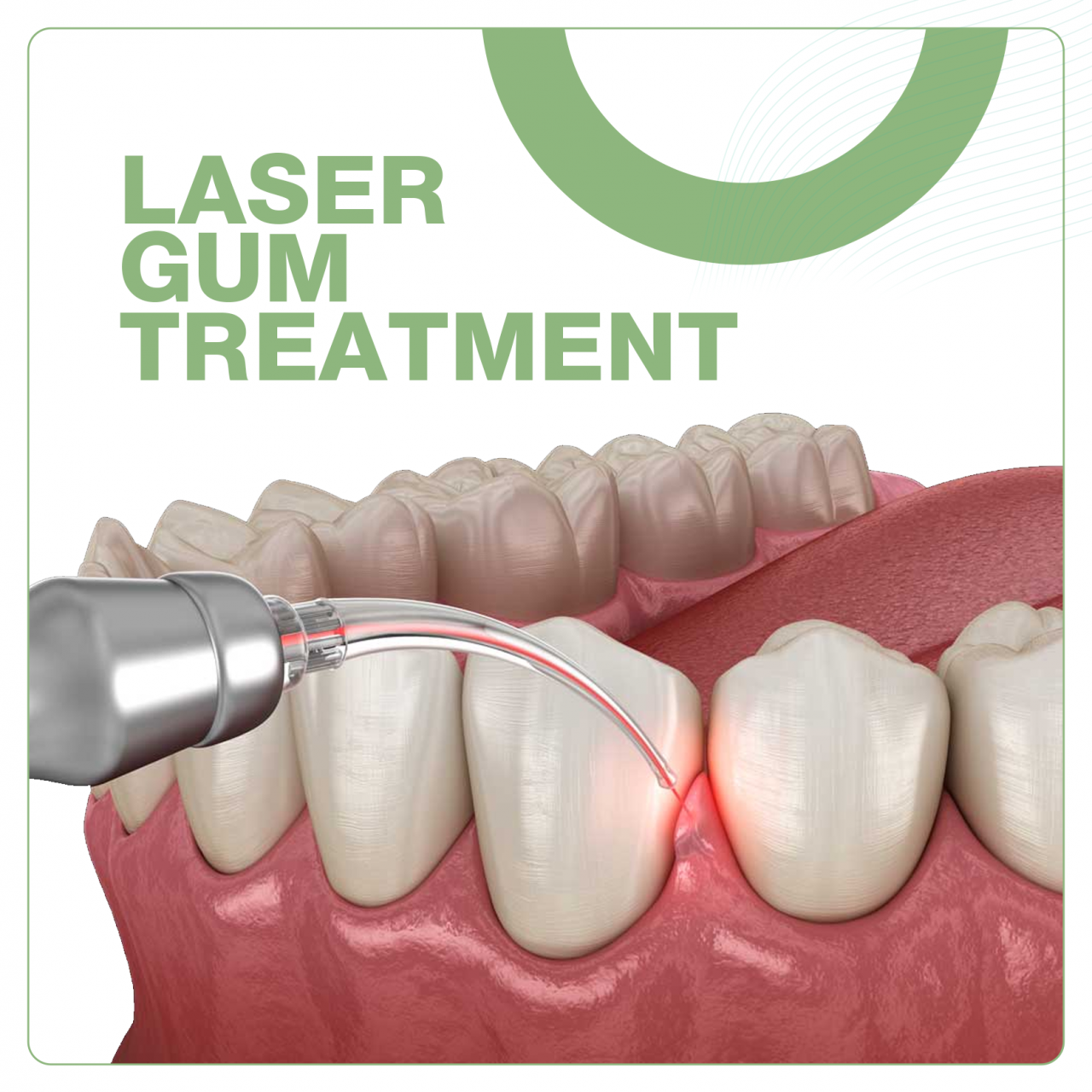 Laser Gum treatment