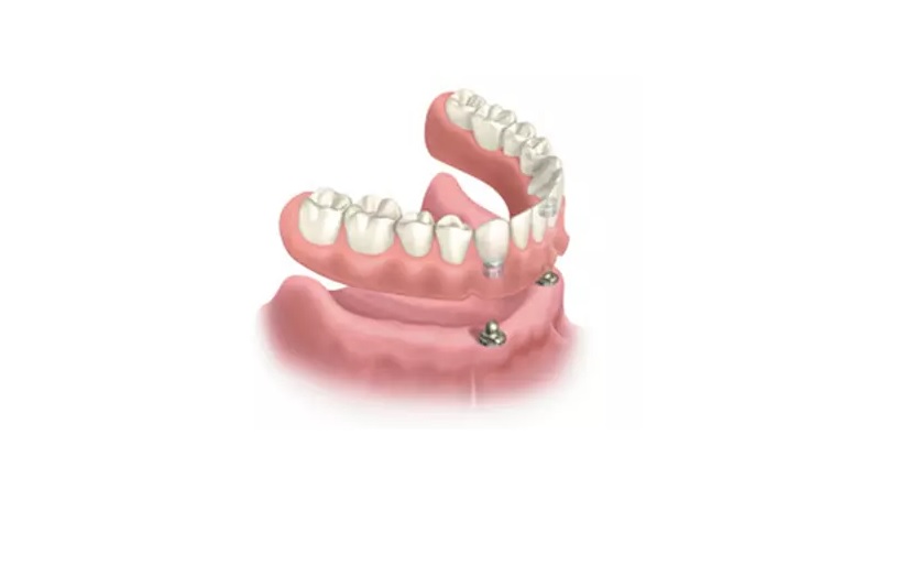 Implant Snap on  or Implant Overdenture 